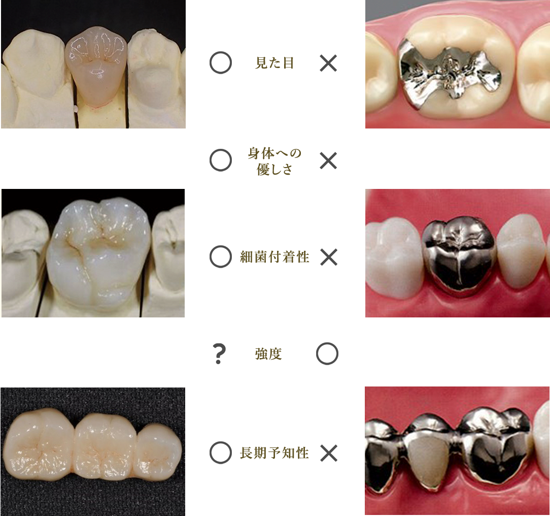 ジルコニア（メタルフリー）治療VS銀歯治療