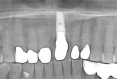 骨が薄い方（歯を失ってから時間が経っている方）でインプラント1本の場合