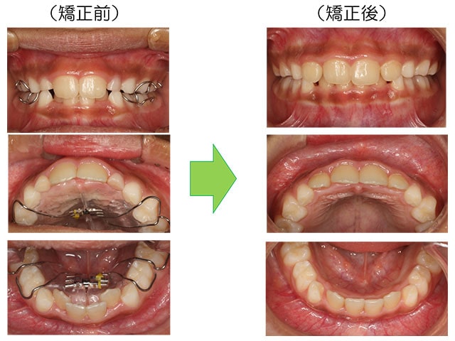 矯正前と矯正後