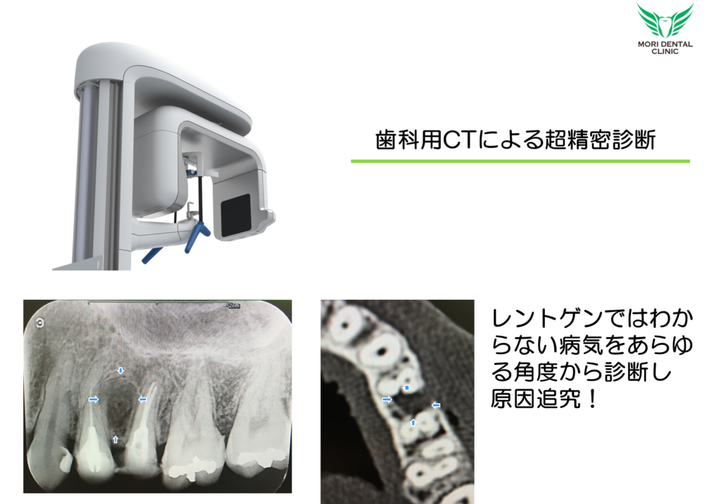 歯科用ｃｔを用いた治療について もり歯科 姫路市香寺町溝口
